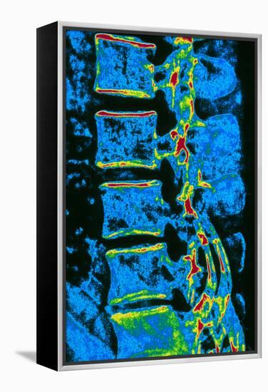 Coloured X-ray of Vertebrae with Osteoporosis-PASIEKA-Framed Premier Image Canvas