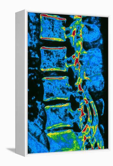 Coloured X-ray of Vertebrae with Osteoporosis-PASIEKA-Framed Premier Image Canvas