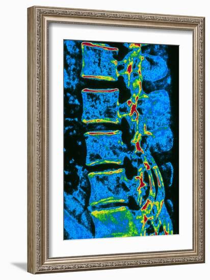 Coloured X-ray of Vertebrae with Osteoporosis-PASIEKA-Framed Photographic Print