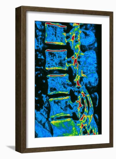 Coloured X-ray of Vertebrae with Osteoporosis-PASIEKA-Framed Photographic Print