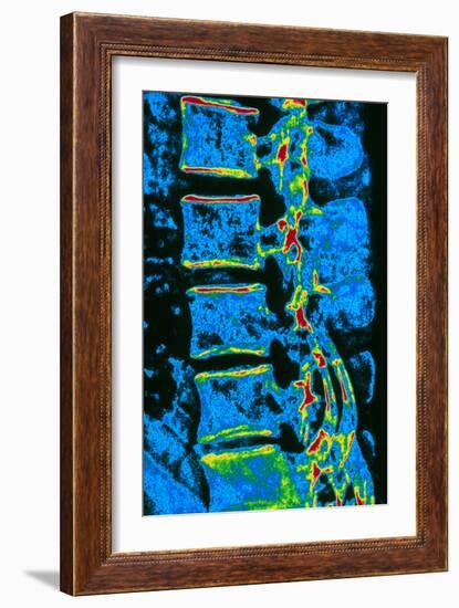 Coloured X-ray of Vertebrae with Osteoporosis-PASIEKA-Framed Photographic Print