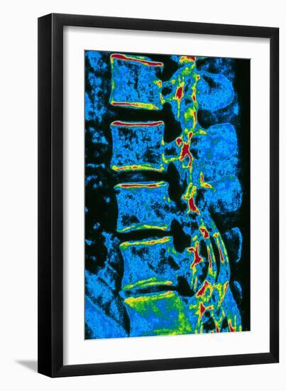 Coloured X-ray of Vertebrae with Osteoporosis-PASIEKA-Framed Photographic Print