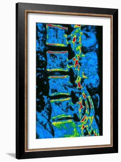 Coloured X-ray of Vertebrae with Osteoporosis-PASIEKA-Framed Photographic Print