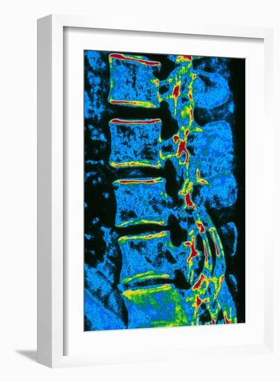 Coloured X-ray of Vertebrae with Osteoporosis-PASIEKA-Framed Photographic Print