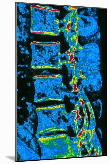Coloured X-ray of Vertebrae with Osteoporosis-PASIEKA-Mounted Photographic Print