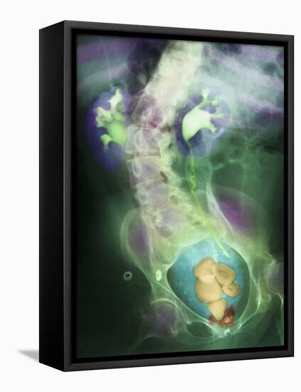 Coloured X-ray Showing Bladder Stones-Science Photo Library-Framed Premier Image Canvas