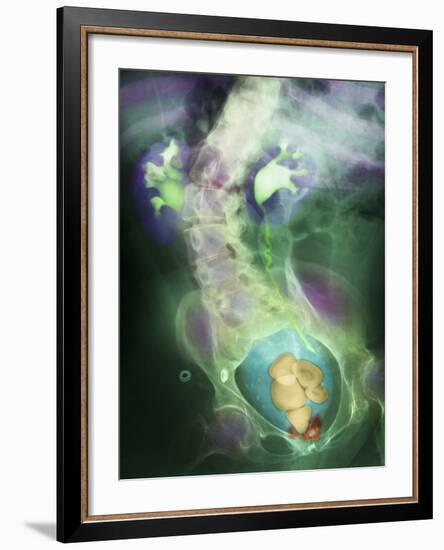 Coloured X-ray Showing Bladder Stones-Science Photo Library-Framed Photographic Print