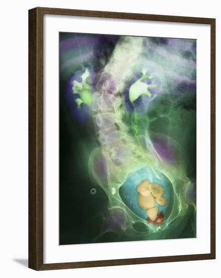 Coloured X-ray Showing Bladder Stones-Science Photo Library-Framed Photographic Print