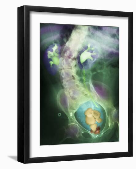 Coloured X-ray Showing Bladder Stones-Science Photo Library-Framed Photographic Print