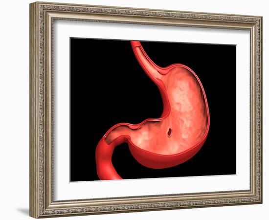 Conceptual Image of Peptic Ulcer in Human Stomach-null-Framed Art Print