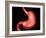 Conceptual Image of Peptic Ulcer in Human Stomach-null-Framed Art Print