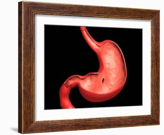 Conceptual Image of Peptic Ulcer in Human Stomach-null-Framed Art Print