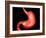 Conceptual Image of Peptic Ulcer in Human Stomach-null-Framed Art Print