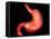 Conceptual Image of Peptic Ulcer in Human Stomach-null-Framed Stretched Canvas