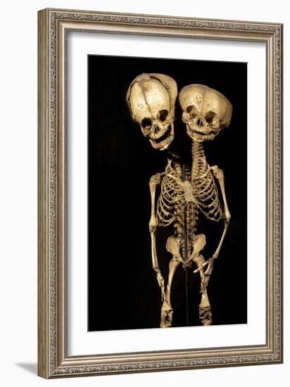 Conjoined Twins-Arno Massee-Framed Photographic Print