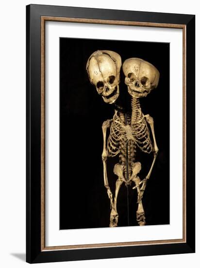 Conjoined Twins-Arno Massee-Framed Photographic Print