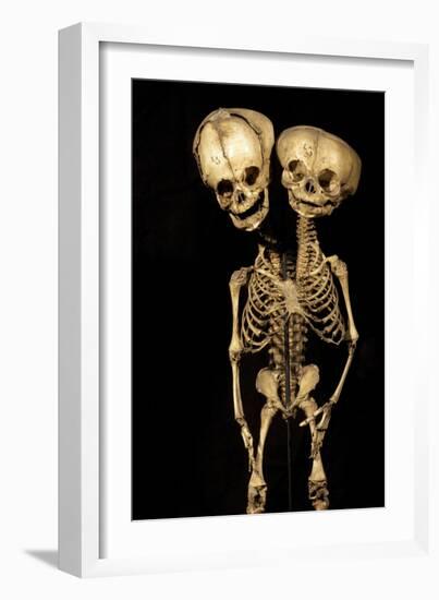 Conjoined Twins-Arno Massee-Framed Photographic Print