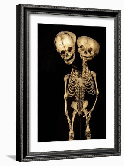 Conjoined Twins-Arno Massee-Framed Photographic Print
