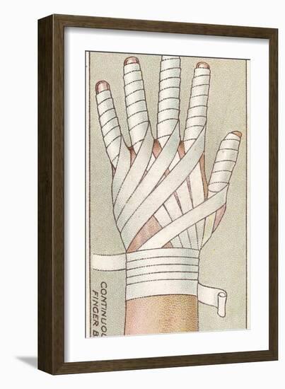 Continuous Finger Bandage, No.48 from the 'First Aid' Series of 'Wills's Cigarettes' Cards, 1913-English School-Framed Giclee Print
