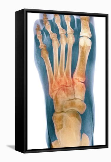 Crushed Broken Foot, X-ray-Science Photo Library-Framed Premier Image Canvas