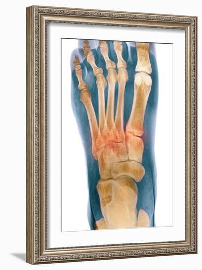 Crushed Broken Foot, X-ray-Science Photo Library-Framed Photographic Print