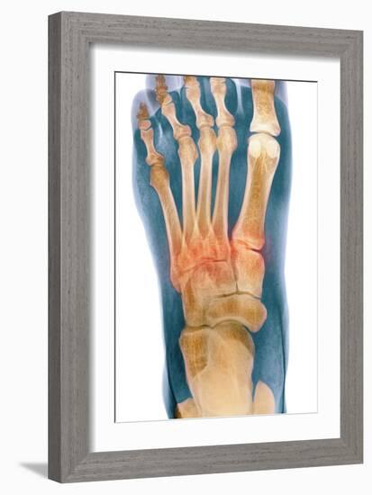 Crushed Broken Foot, X-ray-Science Photo Library-Framed Photographic Print