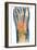 Crushed Broken Foot, X-ray-Science Photo Library-Framed Photographic Print