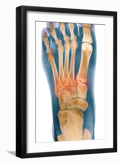 Crushed Broken Foot, X-ray-Science Photo Library-Framed Photographic Print