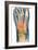 Crushed Broken Foot, X-ray-Science Photo Library-Framed Photographic Print