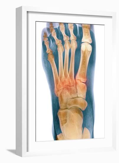 Crushed Broken Foot, X-ray-Science Photo Library-Framed Photographic Print