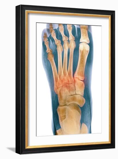 Crushed Broken Foot, X-ray-Science Photo Library-Framed Photographic Print