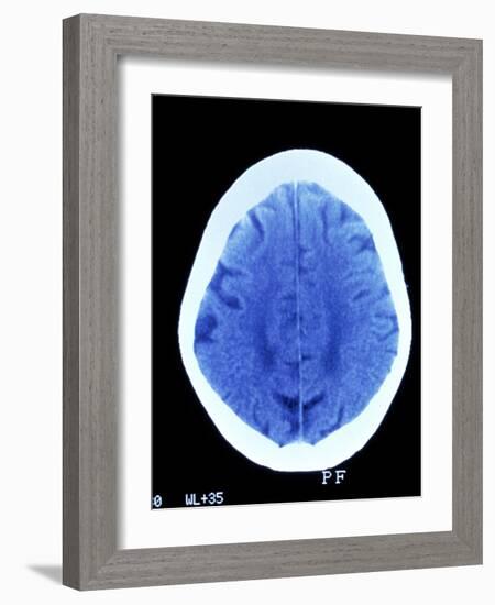 CT Brain Scan of Dementia-Science Photo Library-Framed Photographic Print