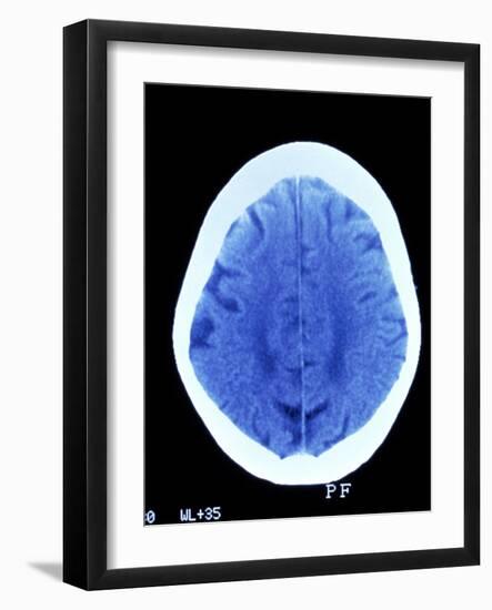 CT Brain Scan of Dementia-Science Photo Library-Framed Photographic Print