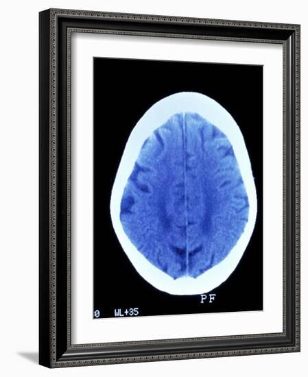 CT Brain Scan of Dementia-Science Photo Library-Framed Photographic Print