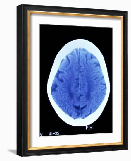 CT Brain Scan of Dementia-Science Photo Library-Framed Photographic Print