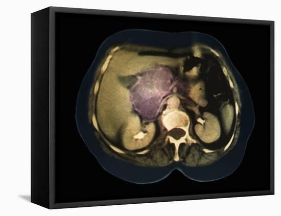 Cystic Pancreas Tumour, CT Scan-ZEPHYR-Framed Premier Image Canvas