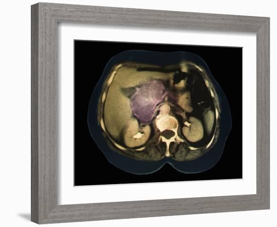 Cystic Pancreas Tumour, CT Scan-ZEPHYR-Framed Photographic Print