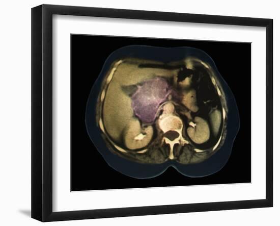 Cystic Pancreas Tumour, CT Scan-ZEPHYR-Framed Photographic Print