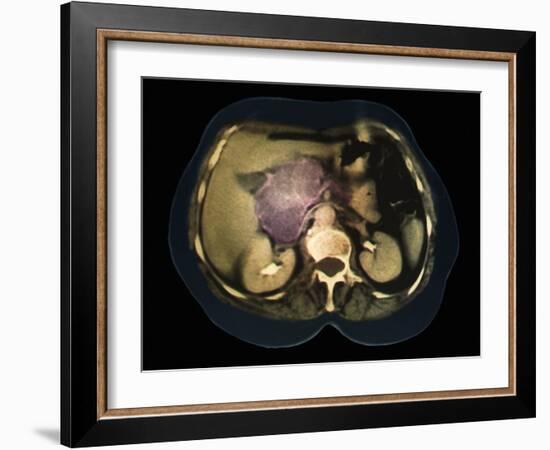 Cystic Pancreas Tumour, CT Scan-ZEPHYR-Framed Photographic Print