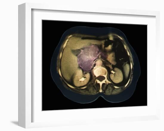 Cystic Pancreas Tumour, CT Scan-ZEPHYR-Framed Photographic Print