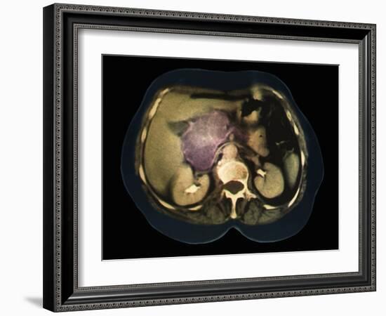 Cystic Pancreas Tumour, CT Scan-ZEPHYR-Framed Photographic Print