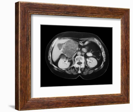 Cystic Pancreas Tumour, CT Scan-ZEPHYR-Framed Photographic Print