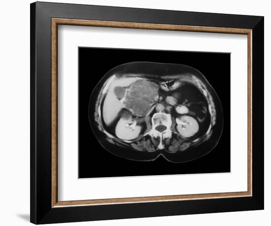 Cystic Pancreas Tumour, CT Scan-ZEPHYR-Framed Photographic Print