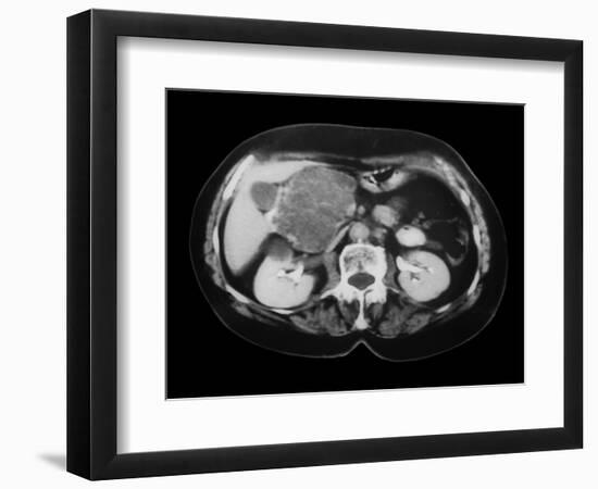 Cystic Pancreas Tumour, CT Scan-ZEPHYR-Framed Photographic Print