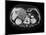 Cystic Pancreas Tumour, CT Scan-ZEPHYR-Mounted Photographic Print