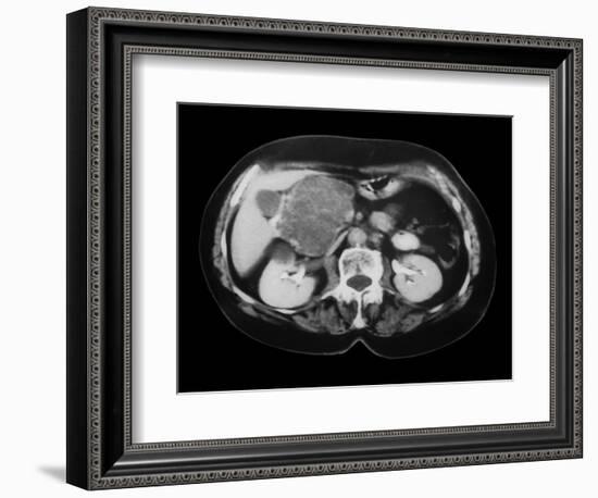 Cystic Pancreas Tumour, CT Scan-ZEPHYR-Framed Photographic Print