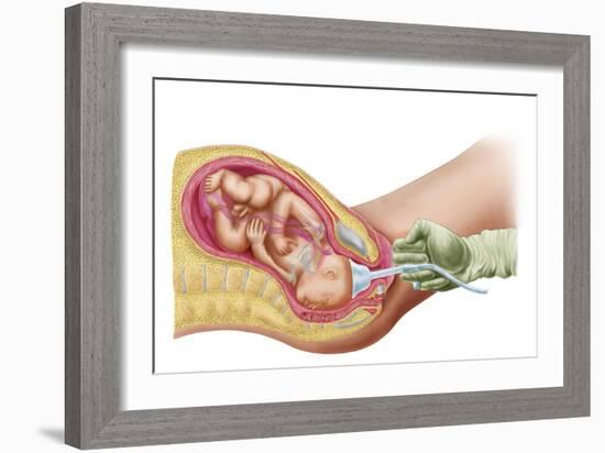 Delivery of Fetus Using Vacuum Extraction Due to Shoulder Dystocia-null-Framed Art Print