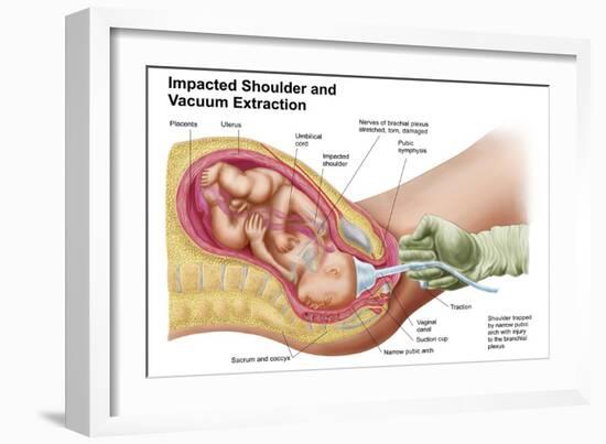 Delivery of Fetus Using Vacuum Extraction Due to Shoulder Dystocia-null-Framed Art Print