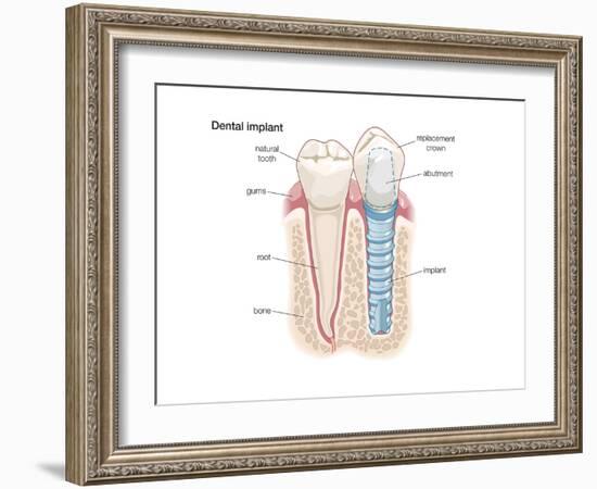 Dental Crown. Dentistry, Endodontics, Teeth, Tooth Damage, Oral Health, Health and Disease-Encyclopaedia Britannica-Framed Art Print
