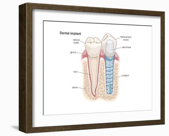 Dental Crown. Dentistry, Endodontics, Teeth, Tooth Damage, Oral Health, Health and Disease-Encyclopaedia Britannica-Framed Art Print